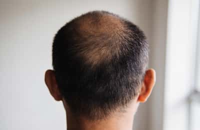 Calvitie masculine : causes, stades et solutions