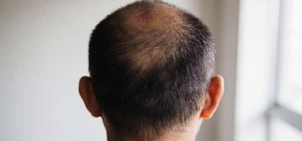 Cheliția masculină: Cauze, stadii și ce ajută